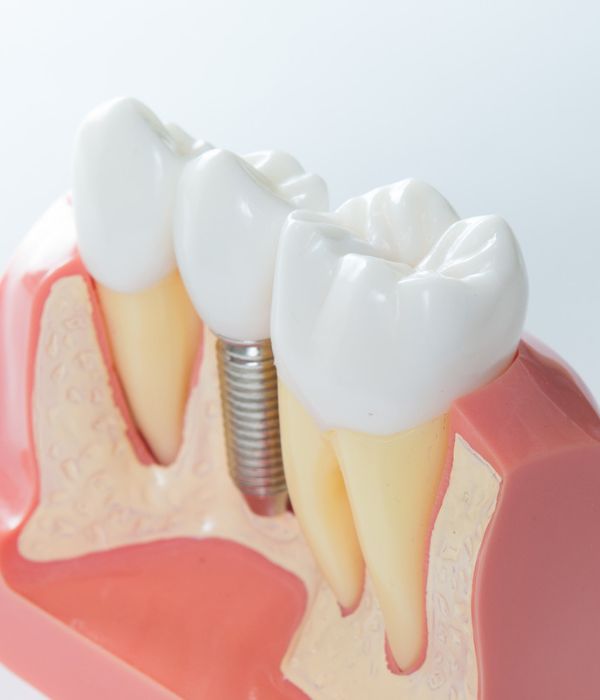 Dental Implants A tooth implant is placed in the lower jaw.