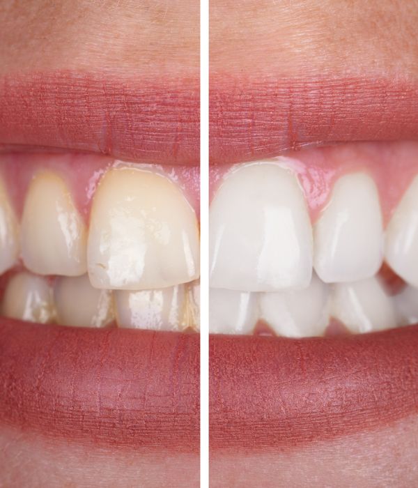 Teeth Whitening A before and after picture of teeth whitening