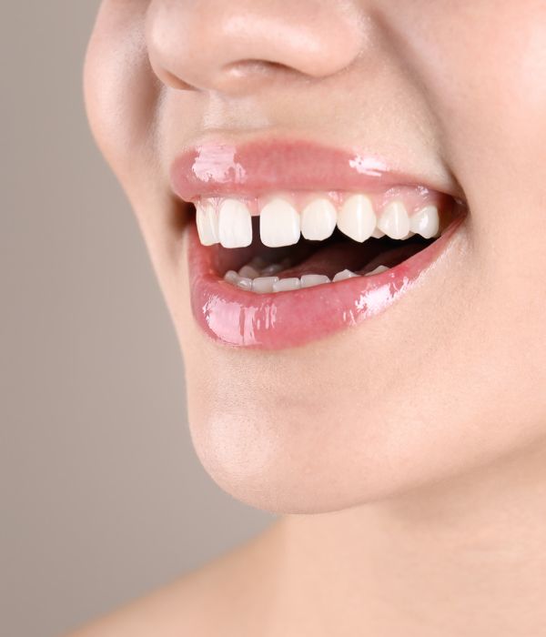 Tooth Bonding A woman with pink lips and white teeth smiling.